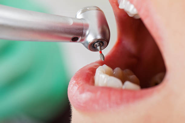 Best Urgent Care for Lost Fillings or Crowns in Sturgis, SD